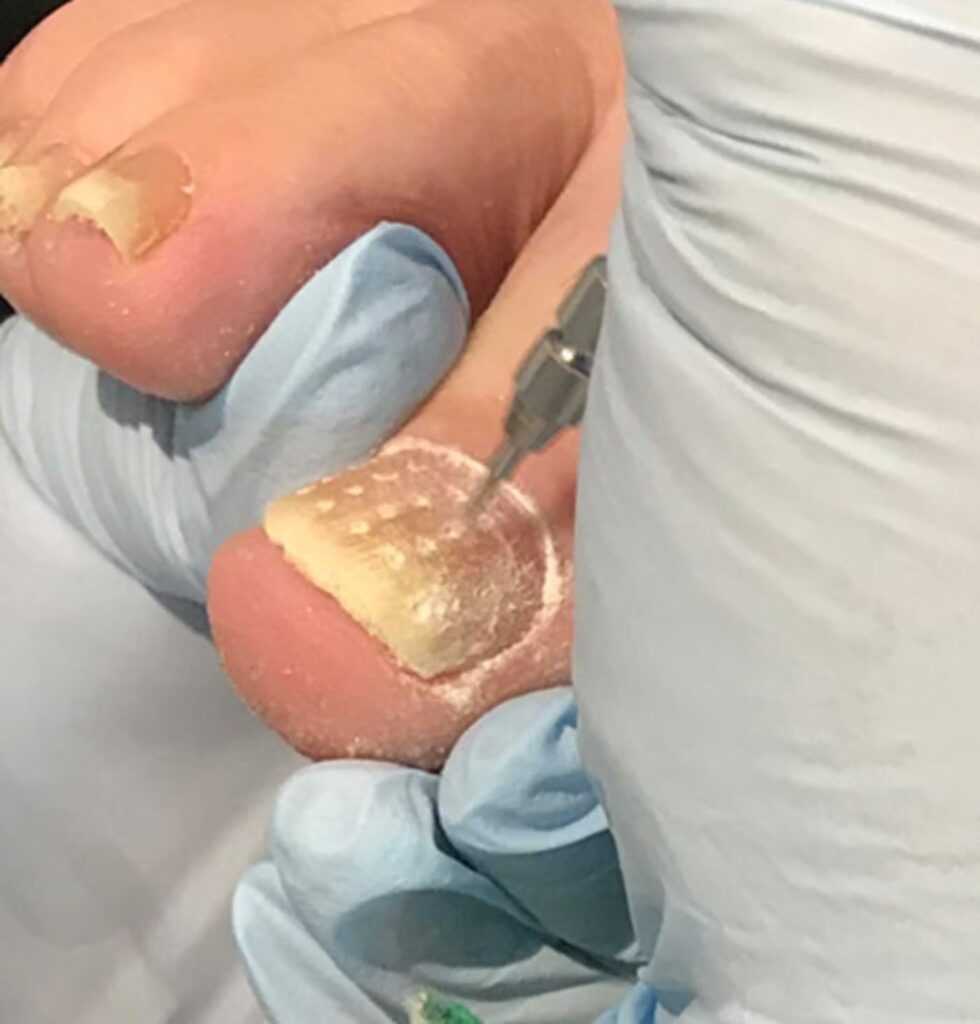 Lacuna Fungal Nail Treatment 3 Lacuna Image 1