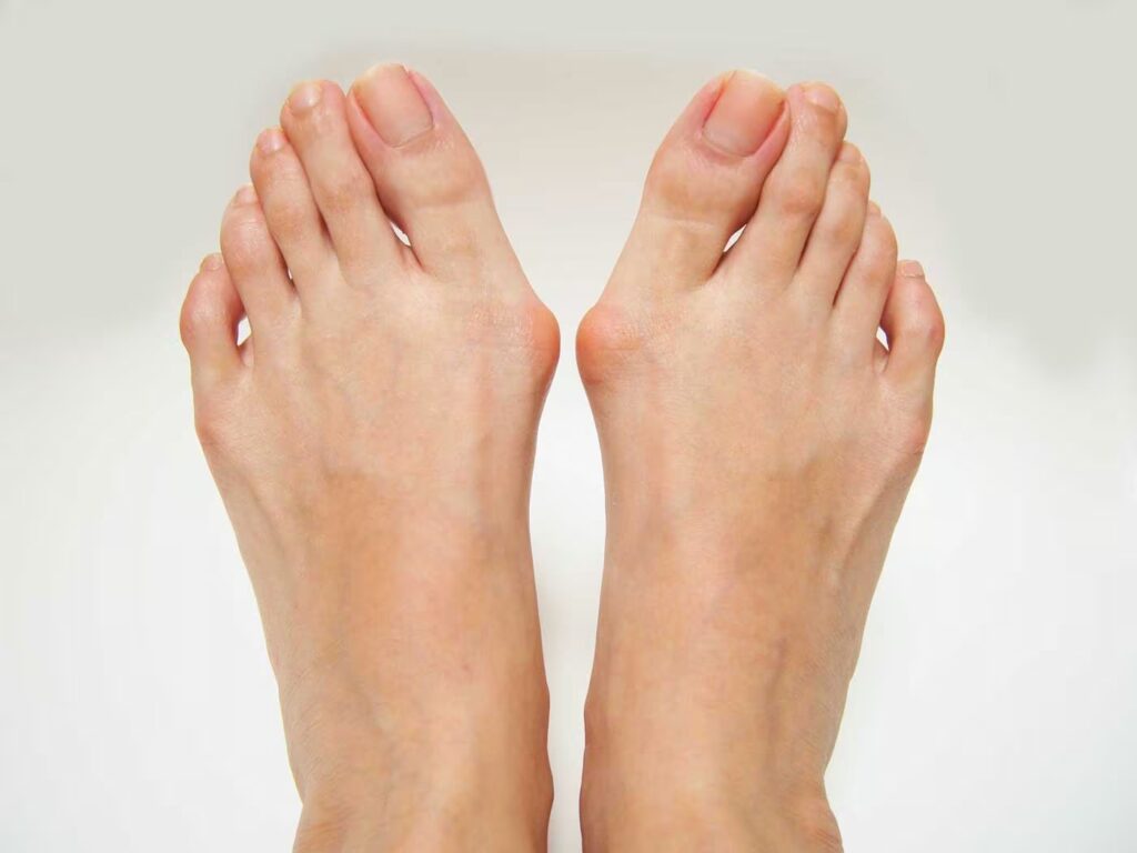 Bunions 1 shutterstock 1174407688