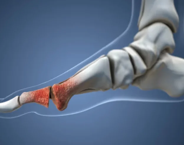 Living With Osteoarthritis Can MLS Laser Therapy Help